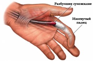 Болезни суставов пальцев рук